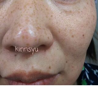 オバジ ８日目 シミが消えましたよ ホントに 子宮筋腫から突然 子宮体ガン 宣告されちゃいました