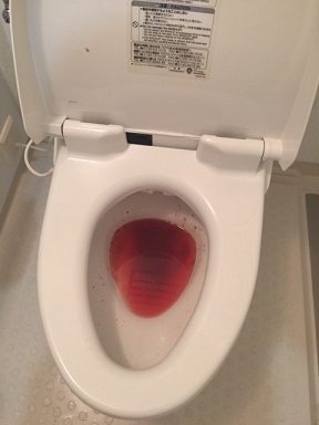 潰瘍性大腸炎 血便
