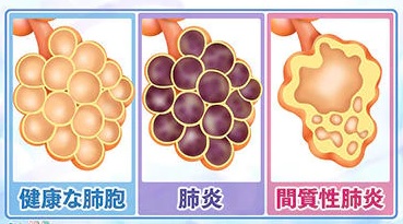 間 質 性 肺炎 治る