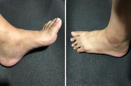 捻挫2