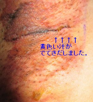 右ワキアップ
