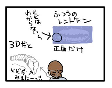 歯 抜歯 ひび 治療 割れ イラスト 漫画