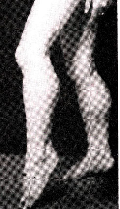 female Duchenne
