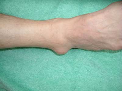 包 くるぶし 液 滑 炎 滑液包炎とは？肘や足首に水が溜まる原因と治療法