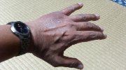 初日の腫れ