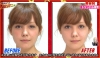 トリンドル玲奈 美容鍼