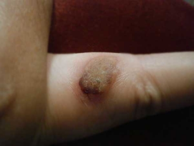 イボを液体窒素で焼いた直後