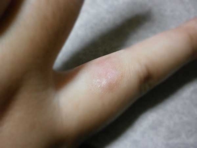 イボ治療の3ヶ月後