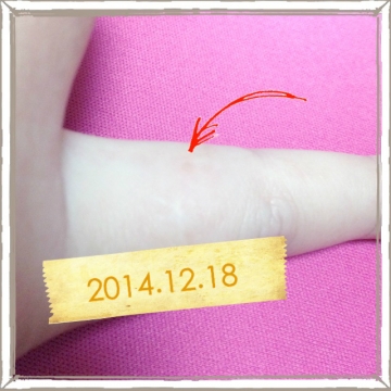 液体窒素でイボをとってみた その一年半後