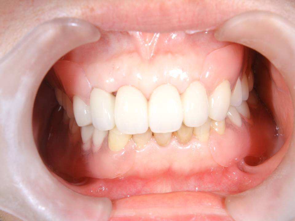 denture1