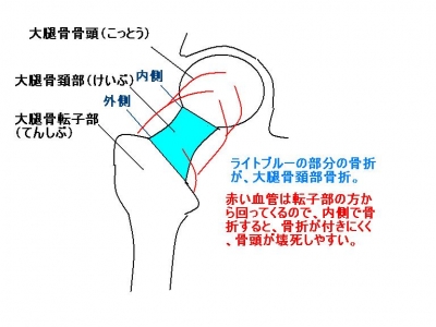 大腿骨について：看護師のお悩み相談室