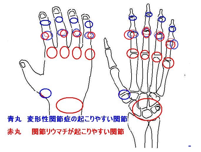 手の関節