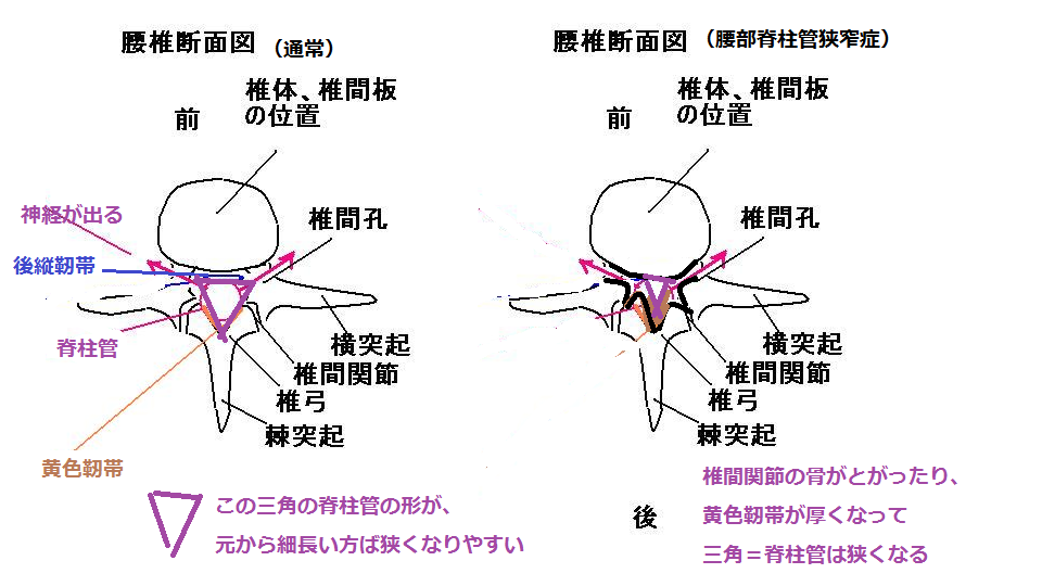 腰の脊柱管の変形
