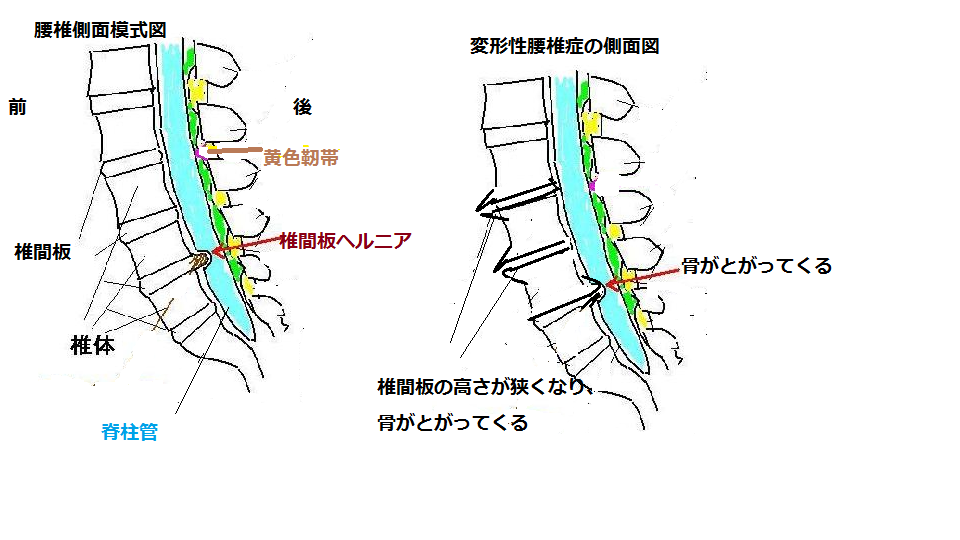 変形性腰椎症側面
