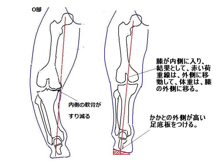 O脚