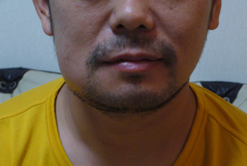 頬腫れる こてなっち