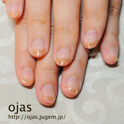 深爪矯正ビフォーアフター １ヶ月経過でピンク部分が伸びました 深爪 噛み爪 二枚爪の改善は京都ネイルサロンojas オージャス へ