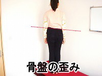 骨盤ズレ