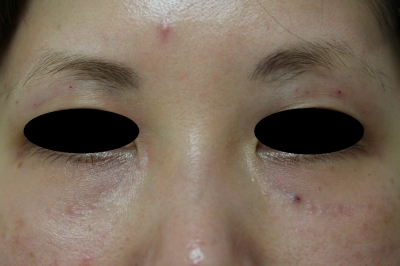 くぼみ目と目の下のくぼみへのヒアルロン酸注入 美容のかかりつけ医を目指して