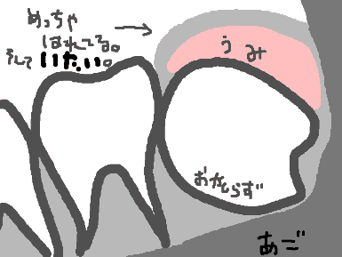 わたくしの左奥歯の様