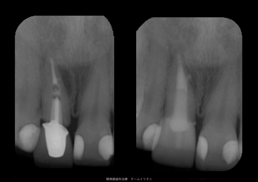 根管治療 根管充填 東京高画質マイクロctスキャン顕微鏡歯科治療アシスタントyu イリタニオフィス 東京顕微鏡歯科専門歯科衛生士yu