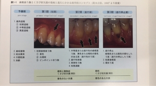根面う蝕の予防処置と治療方針 東京歯科大学社会歯科学研究室