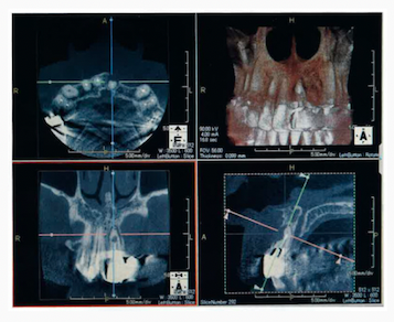 歯科衛生士国家試験に歯科用コーンビームCTが出題されています