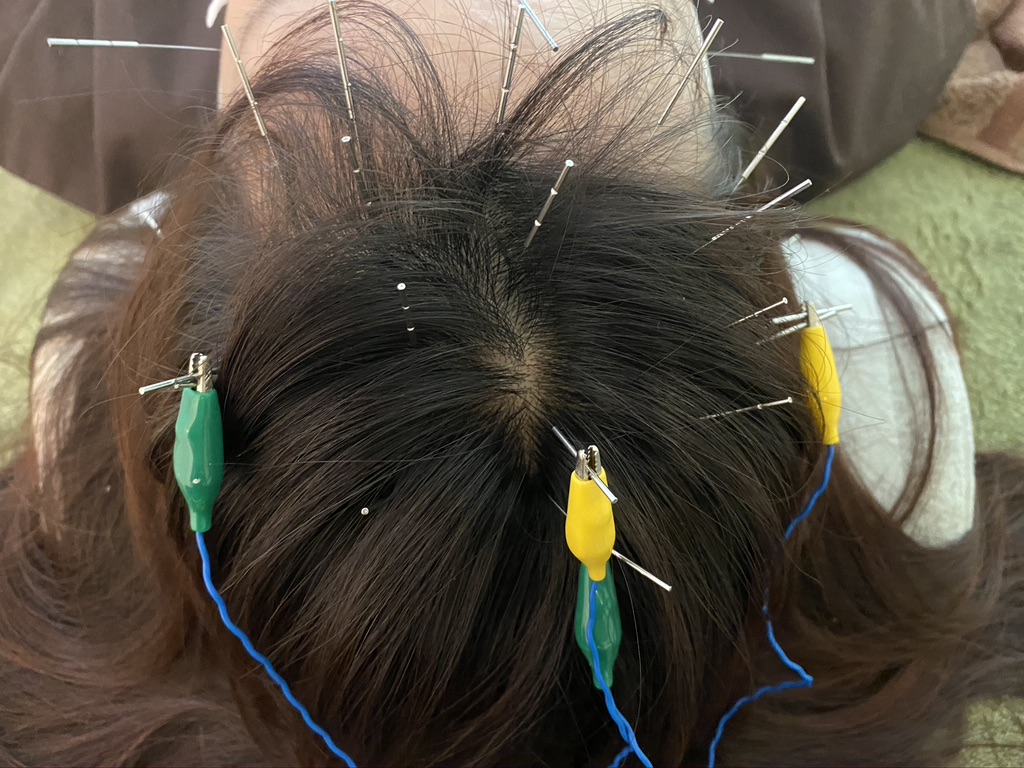 髪悩みは頭皮鍼 育毛鍼で解決できる 美容や健康にも嬉しい効果とは ハリのち晴れ 鍼灸治療院