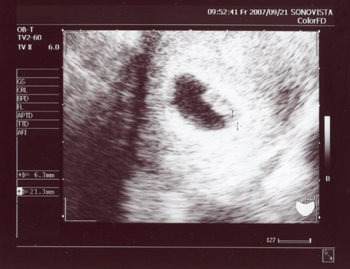 妊娠記録 ７週２日目の子宮内エコー 夫から見た妻の妊娠記録