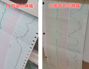 陣痛波形の比較