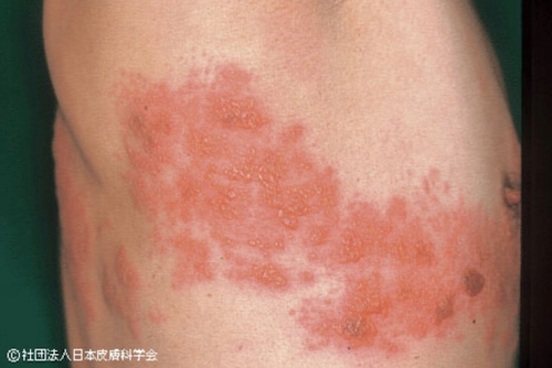 この帯状疱疹の写真は、公益社団法人日本皮膚科学会のＨＰより。