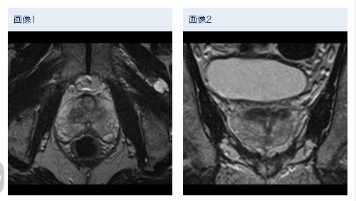 前立腺