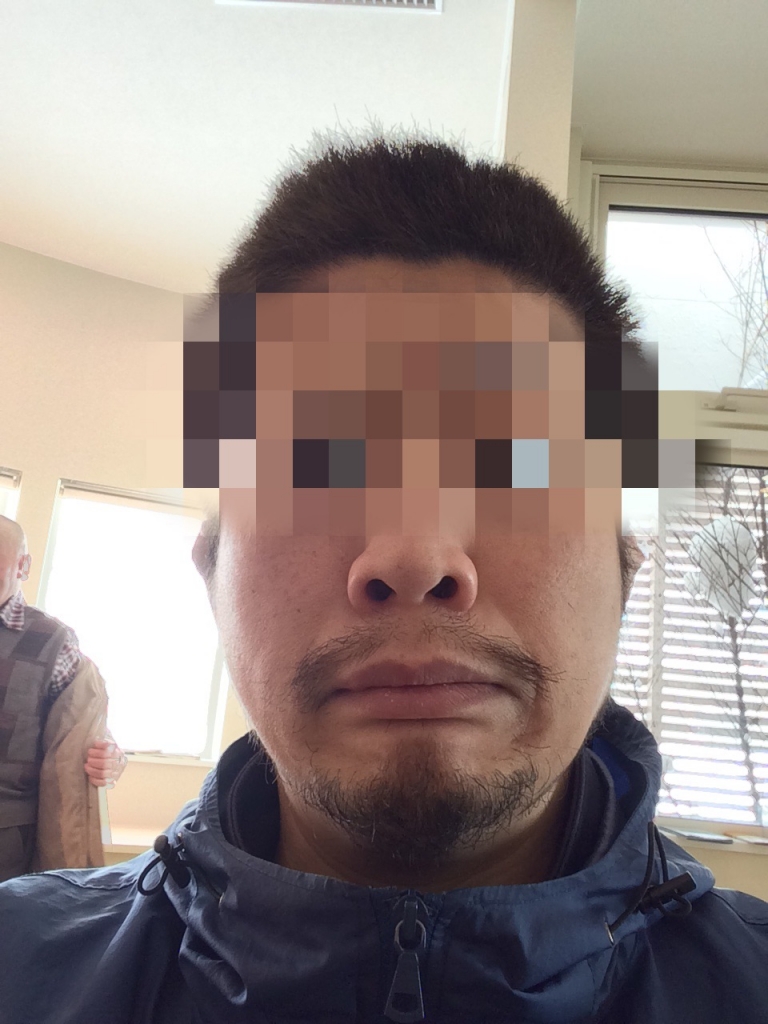 たら 親知らず 小 顔 抜い