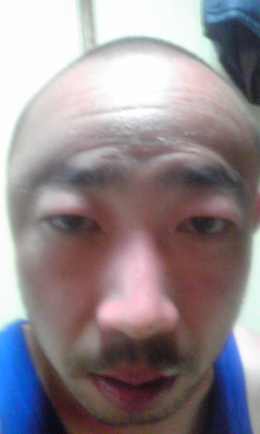 陽射しで頭が腫れた Kyuubu Fc Official Blog