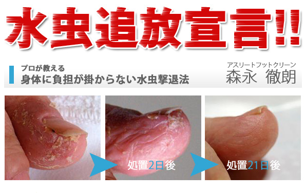 水虫アッサリ追放宣言! 自宅で簡単除去方法