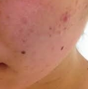 デコボコしたニキビ跡を薬用アクレケアで治せた感動