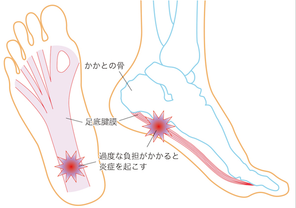 かかとの痛み