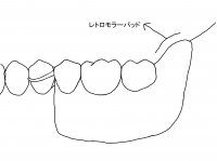 理想的な義歯