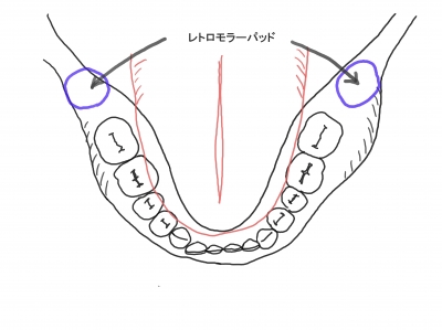 レトロモラーパッド