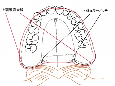 上顎義歯後縁