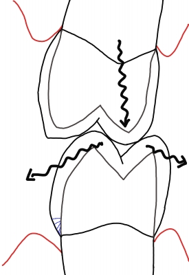 側方運動