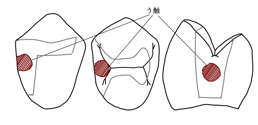 インレー