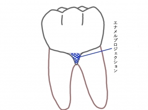 エナメルプロジェクション