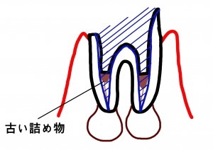 感染根管治療