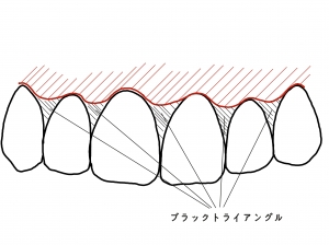 ブラックトライアングル