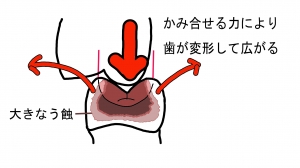 大きなう蝕