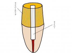 歯牙に当てはめた状態１