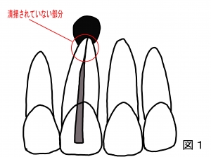 根尖病巣レントゲン