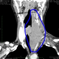 デスモイド腫瘍 CT 首