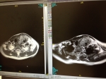 MRI デスモイド腫瘍
